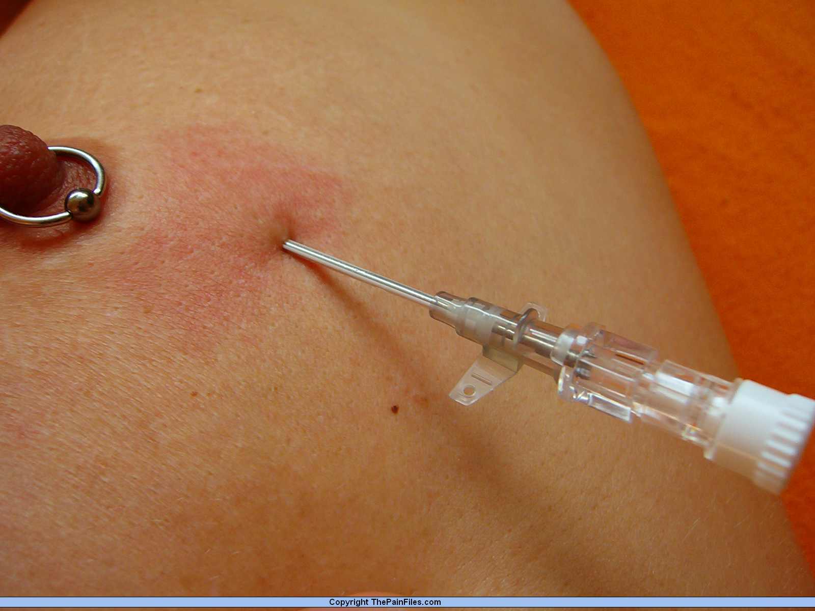 Needle Injection - Saline Injection